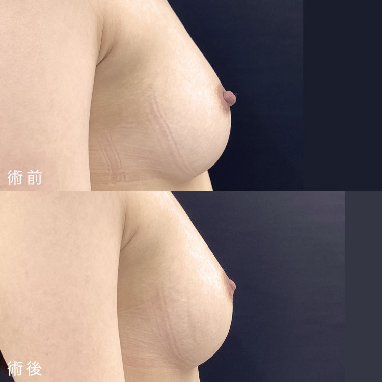 乳頭縮小術症例写真