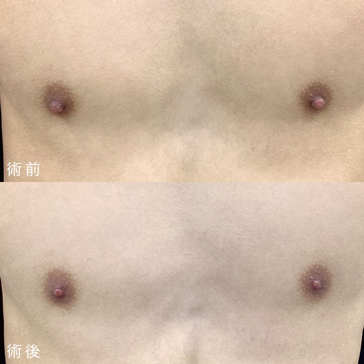乳頭縮小術症例写真