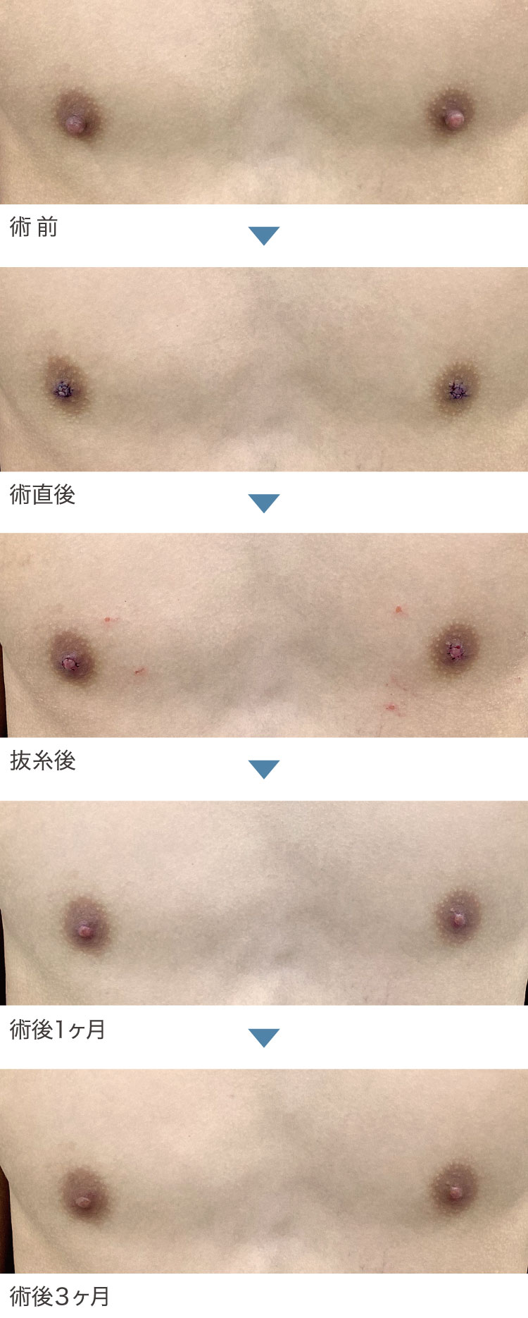 乳頭縮小術症例経過写真