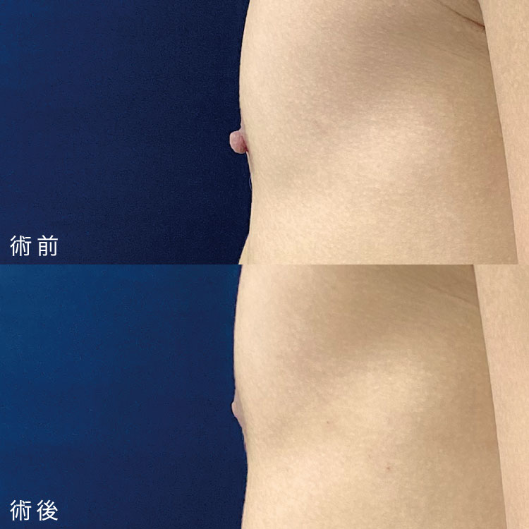 乳頭縮小術症例写真