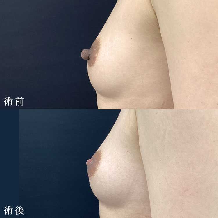乳頭縮小術症例写真