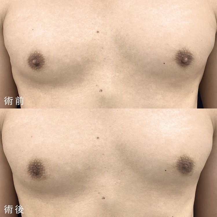 男性の乳頭縮小術 症例写真