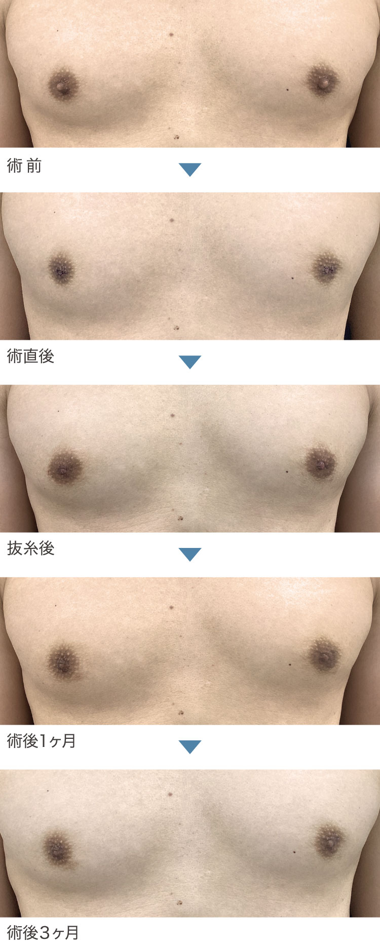 乳頭縮小術症例経過写真