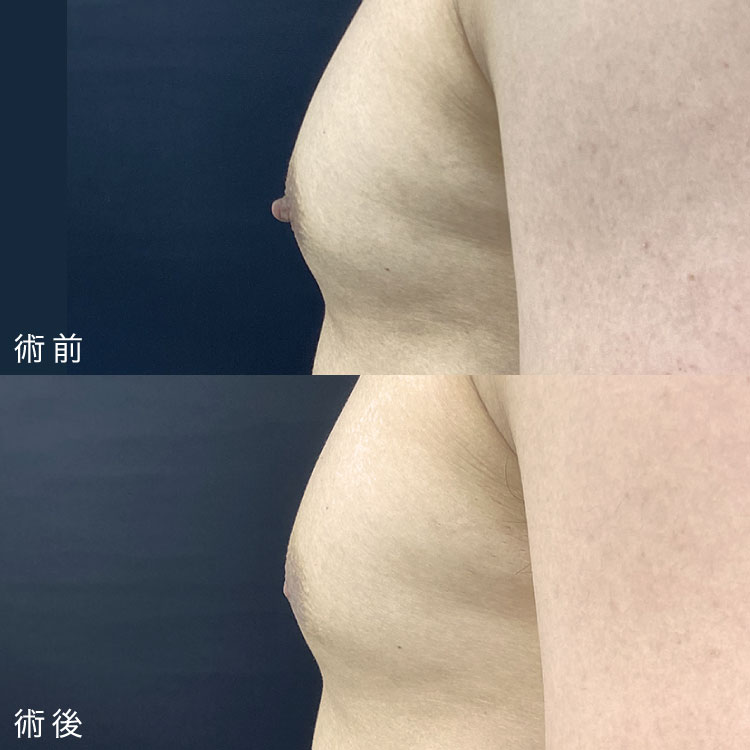 乳頭縮小術症例写真