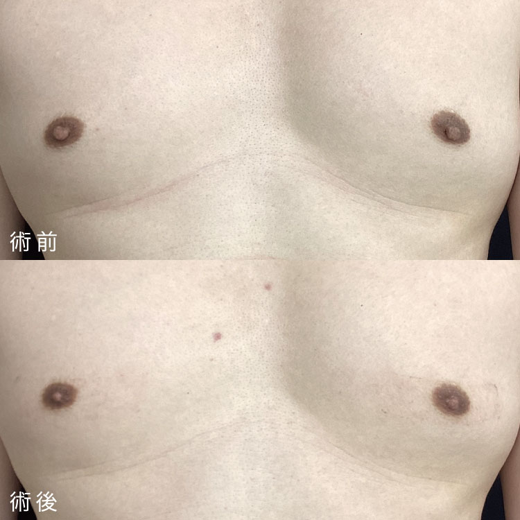 乳頭縮小術症例写真
