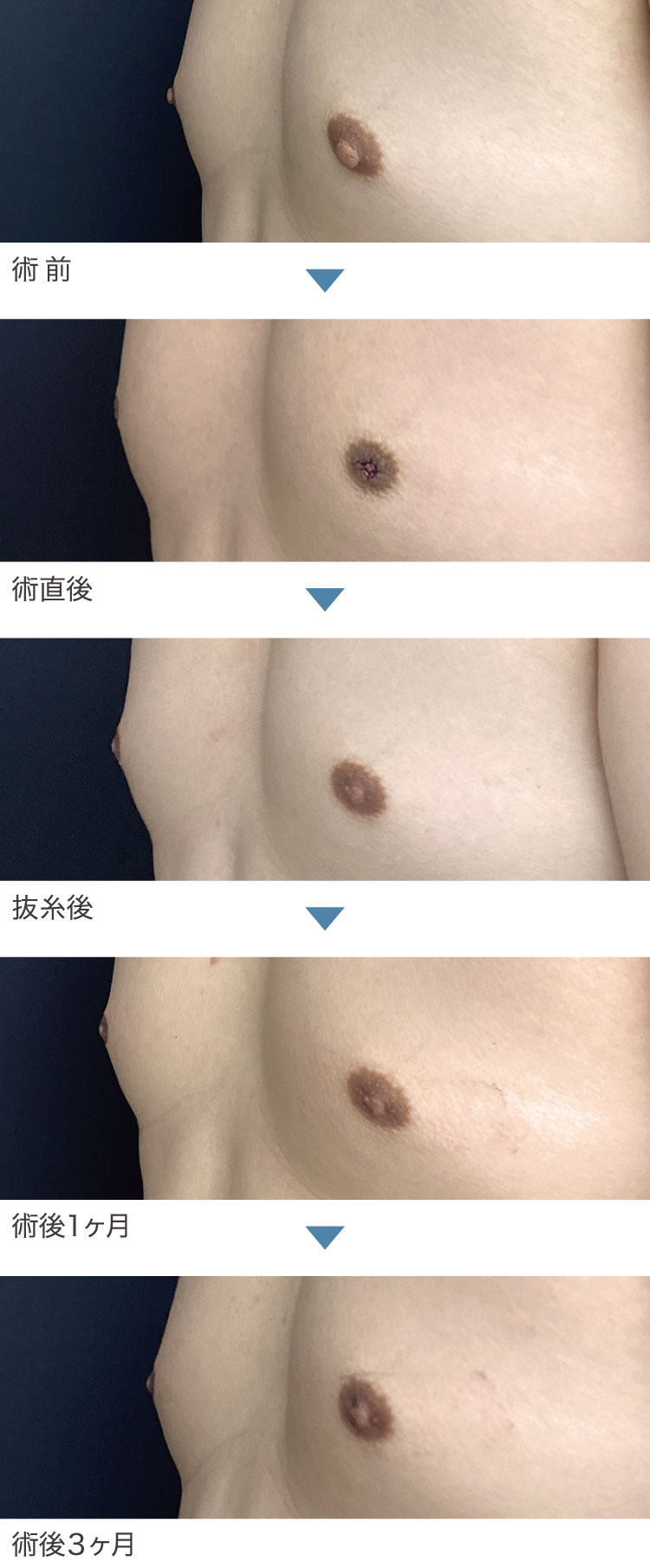 乳頭縮小術症例経過写真