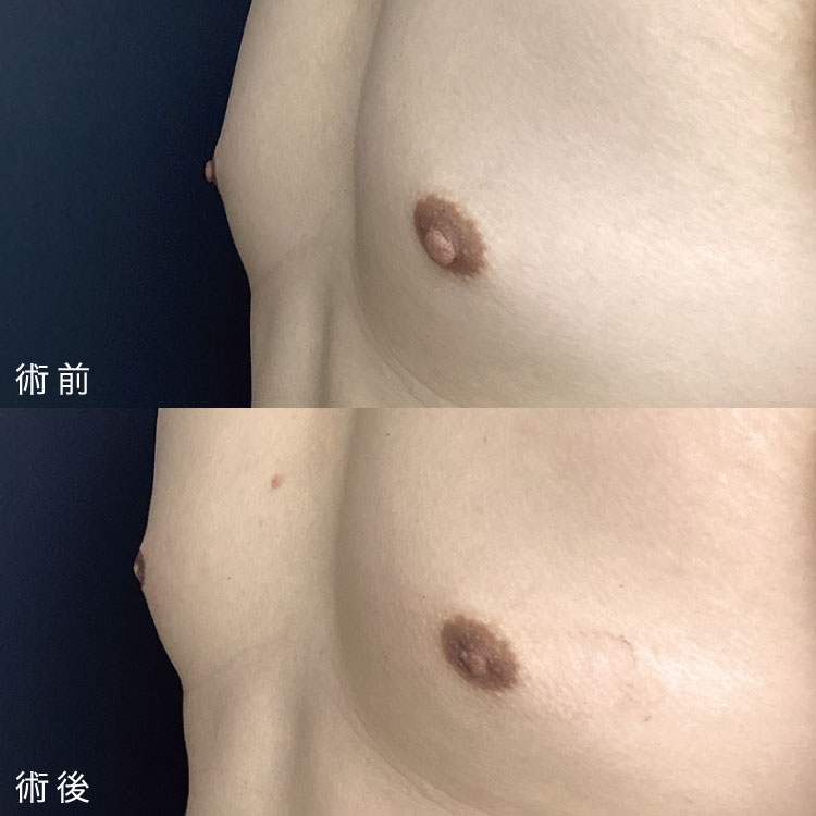乳頭縮小術症例写真