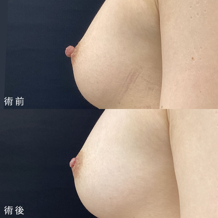 乳頭縮小術症例写真