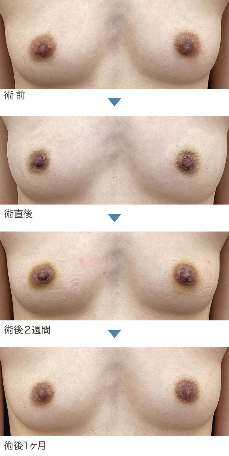 乳頭縮小術症例経過写真