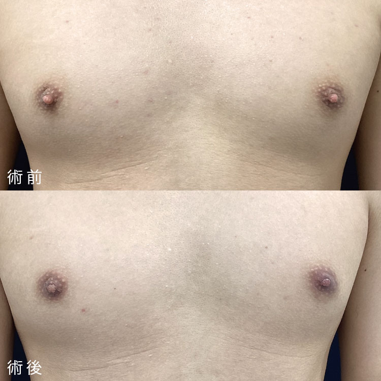 乳頭縮小術症例写真