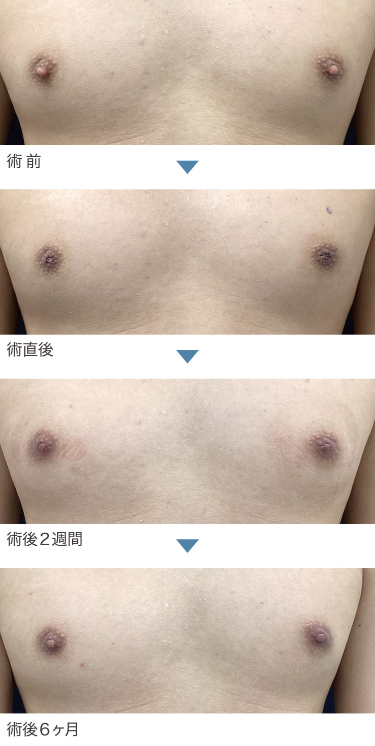 乳頭縮小術症例経過写真