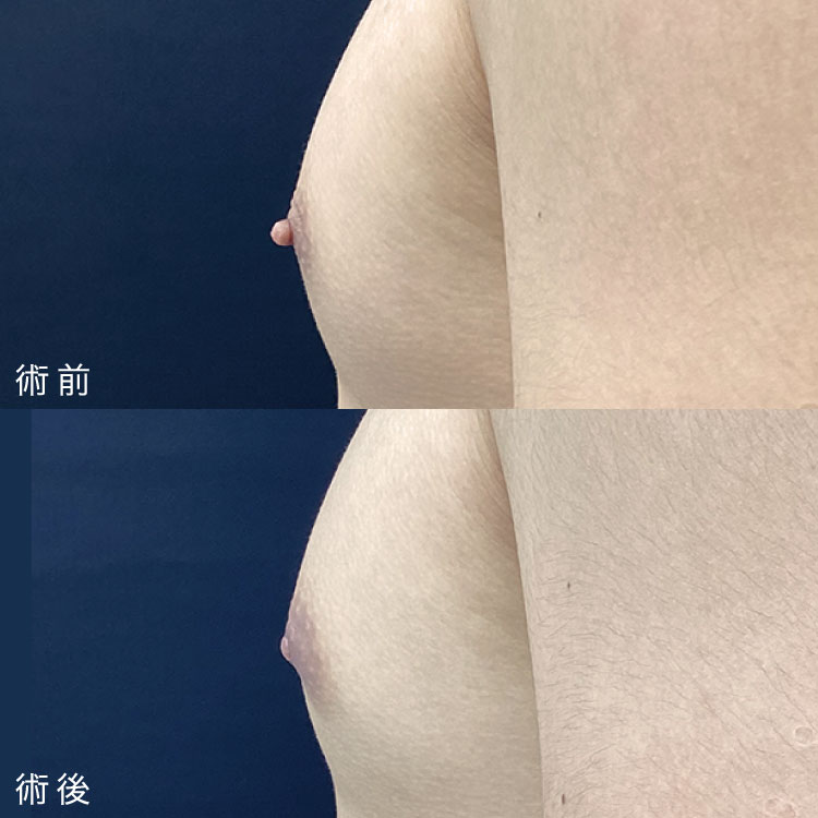 乳頭縮小術症例写真