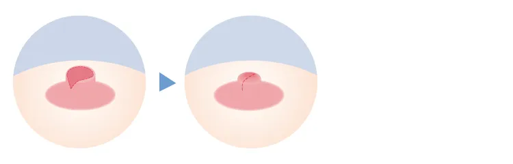 V字状切除術のイメージ