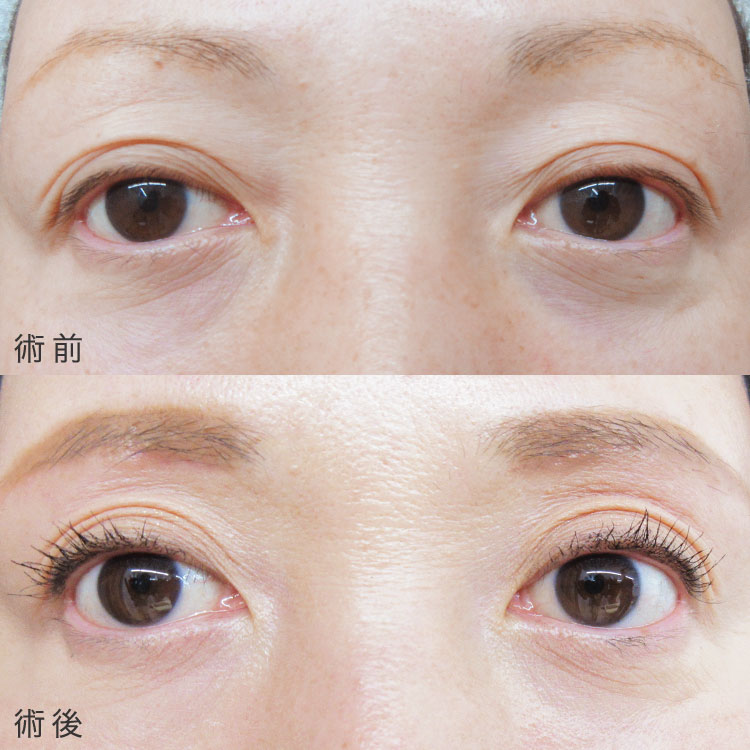 眼瞼下垂症手術の症例写真
