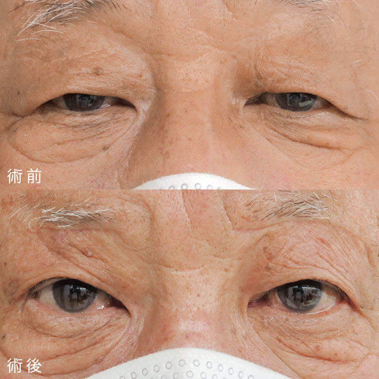 眼瞼下垂症手術の症例写真