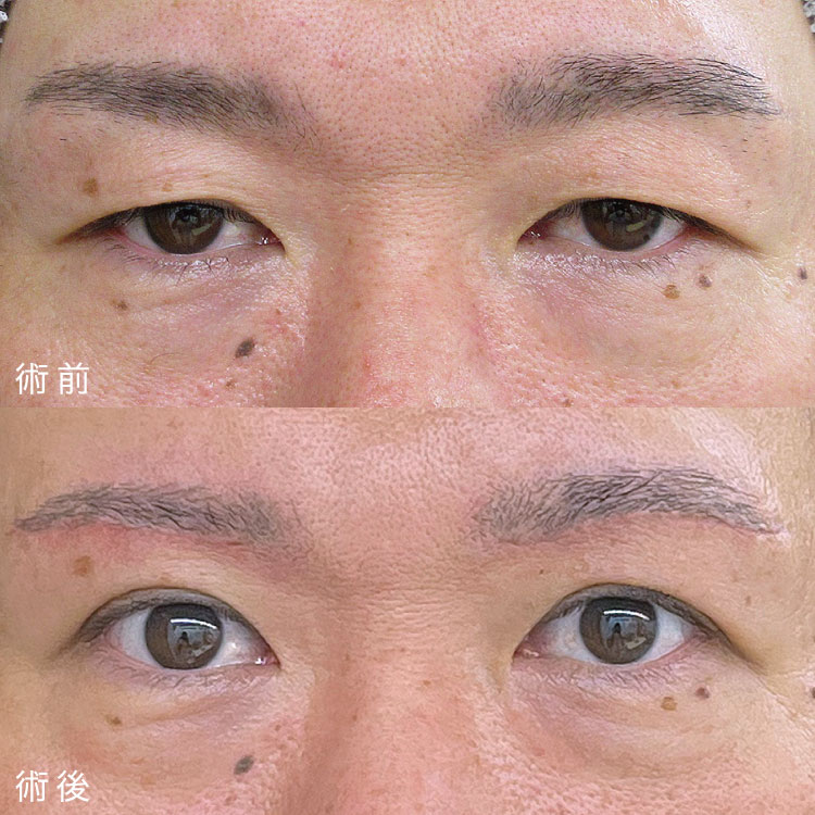 眼瞼下垂症手術の症例写真