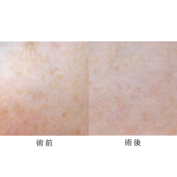 シミ治療の症例写真