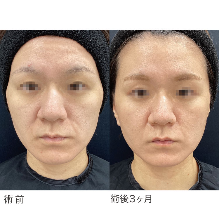 小顔美肌リフトの症例写真
