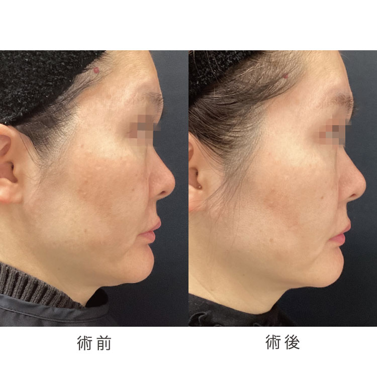 小顔美肌リフト症例写真