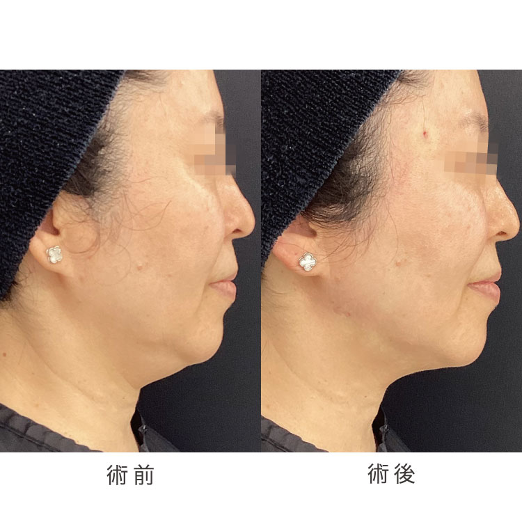 小顔美肌リフトの症例写真