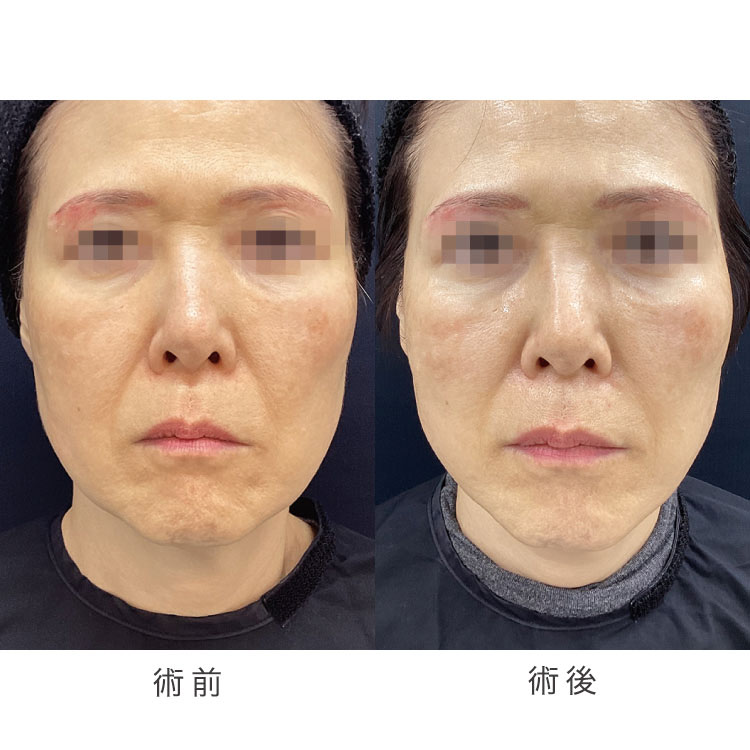小顔美肌リフト（糸リフト）症例写真