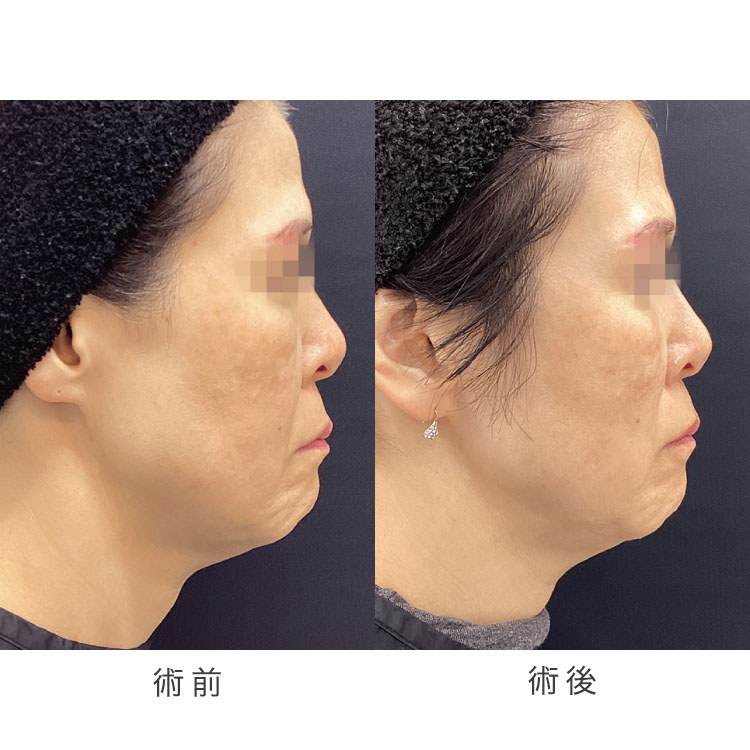小顔美肌リフト（糸リフト）症例写真