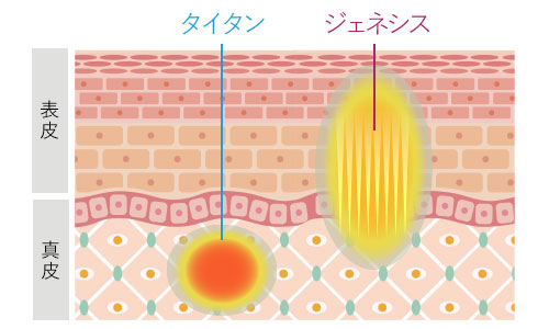 リフトアップコースの作用イメージ