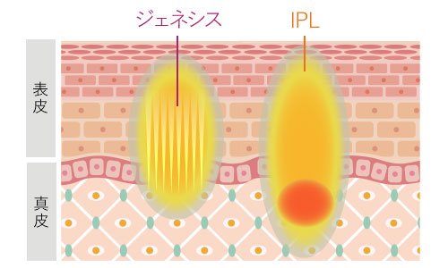 ニキビ跡・赤み改善コースの作用イメージ